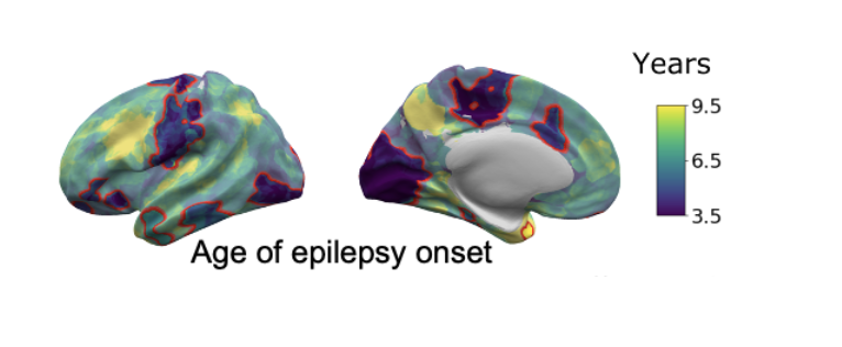 Age of epilepsy onset according to lesion location