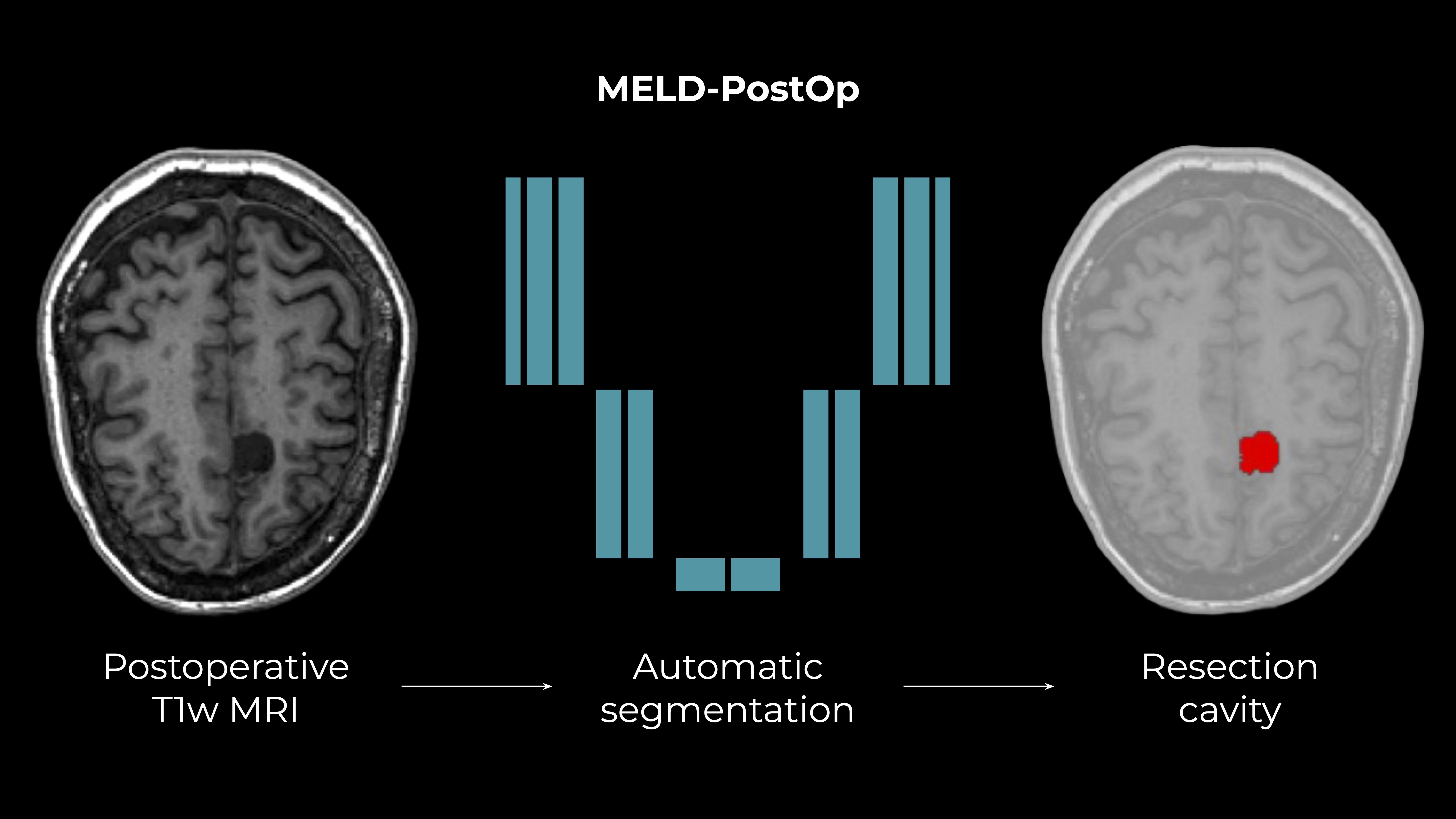MELD PostOp