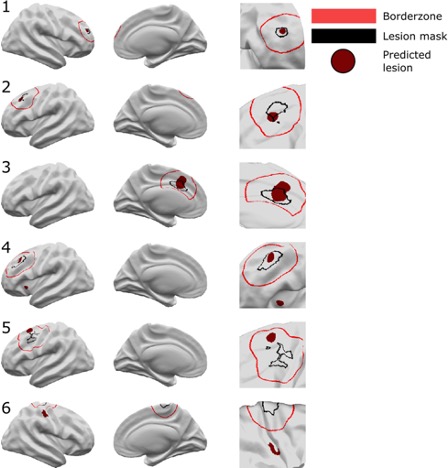 Classifier predictions for six patients. Patients 1–4 are examples where the classifier has correctly identified the lesion. In Patient 4 an additional cluster in the left insula is identified. Patient 5 is an example where the classifier detects an area in the border zone. Patient 6 is an example of where the neural network has not identified the lesion. An additional cluster is detected in the right post-central gyrus.